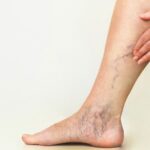 Варикоз на ногах у женщин: причины, симптомы и как его лечить