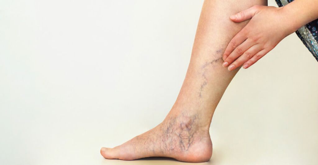 Варикоз на ногах у женщин: причины, симптомы и как его лечить