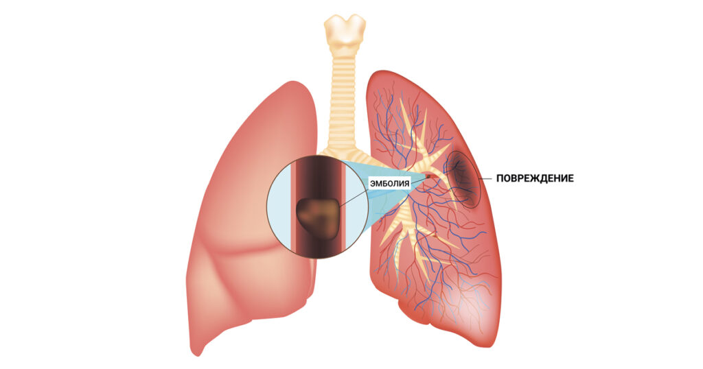 Что такое тромбоэмболия легочной артерии (ТЭЛА) — суть, определение