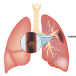 Что такое тромбоэмболия легочной артерии (ТЭЛА) — суть, определение