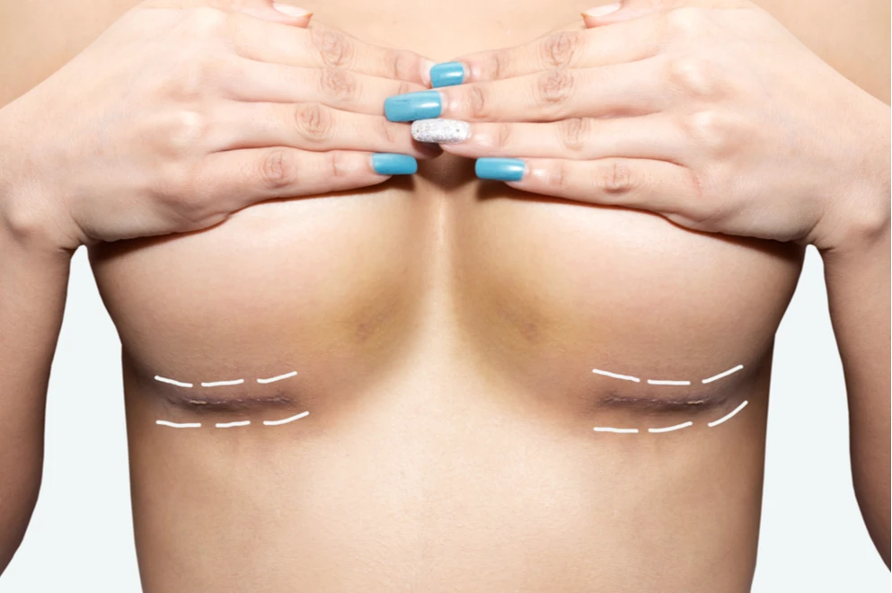 Как увеличить грудь: все методы от безоперационных до хирургических